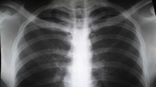 can we know about lung inflammation early