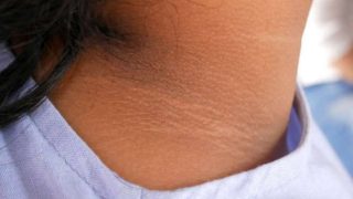 how to get rid of Black neck