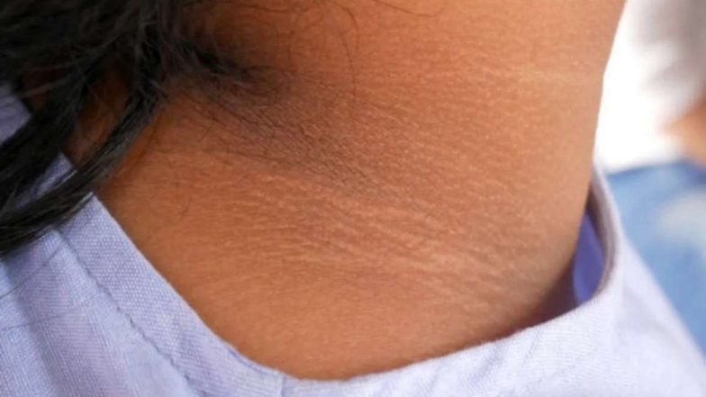 how to get rid of Black neck