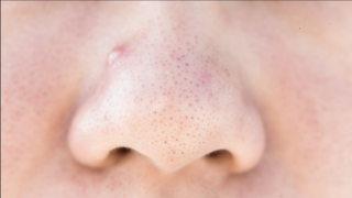 how to get rid of black heads