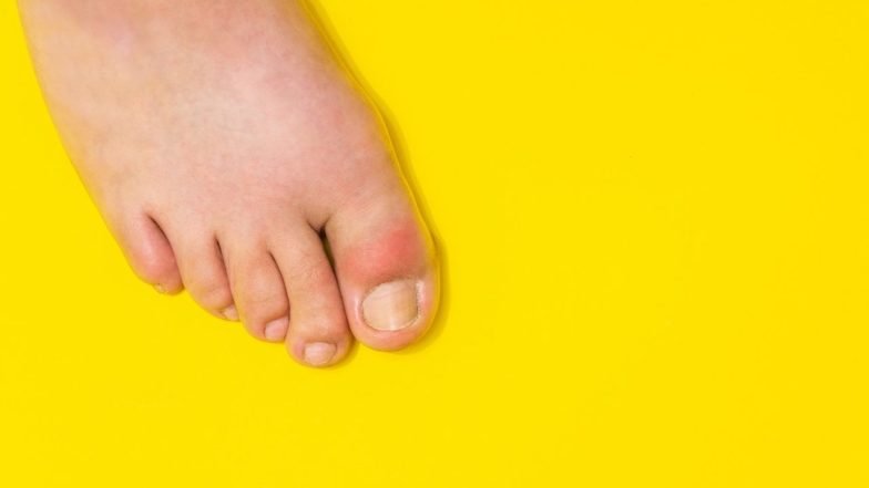 uric acid patients has to stay away from this pulse