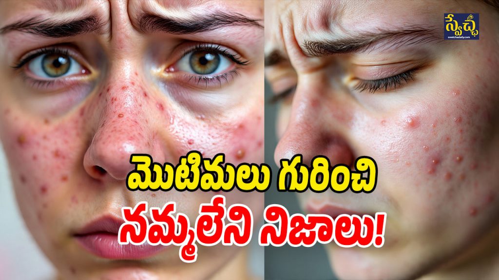 Acne Itching: మొటిమలను పట్టించుకోవట్లేదా.. చిక్కుల్లో పడ్డట్లే!