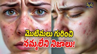 Acne Itching (Image Source: AI)