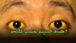 Jaundice ( Image Source: Twitter)