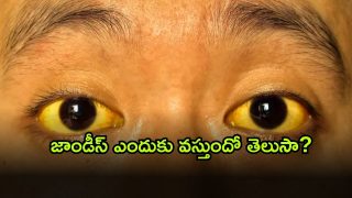 Jaundice ( Image Source: Twitter)