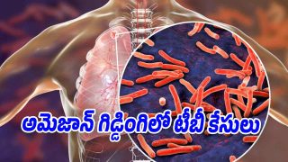 Illustration showing tuberculosis bacteria affecting human lungs